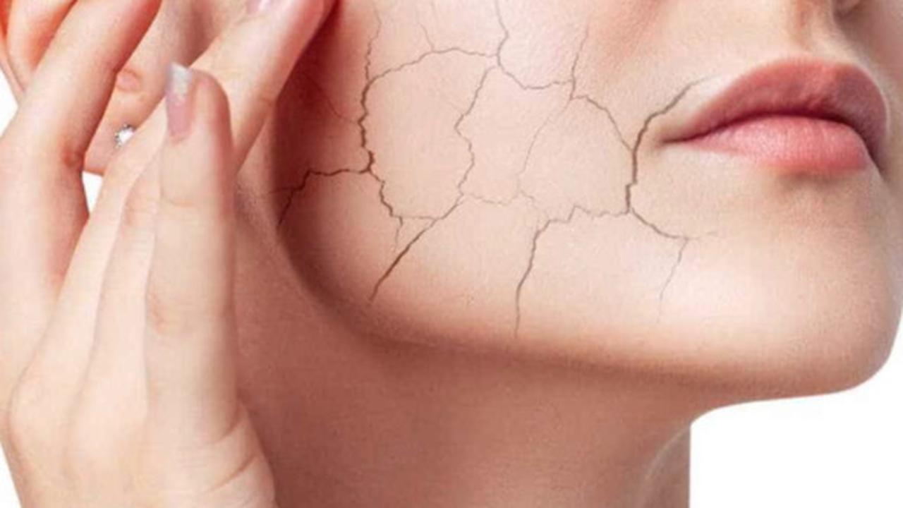 Cara Mengatasi Kulit Mengelupas dengan Efektif dan Aman