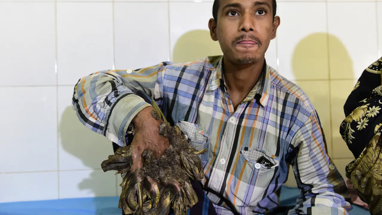 20160130-Miris, di Bangladesh Juga Ada Dede 'Si Manusia Akar'-Bangladesh