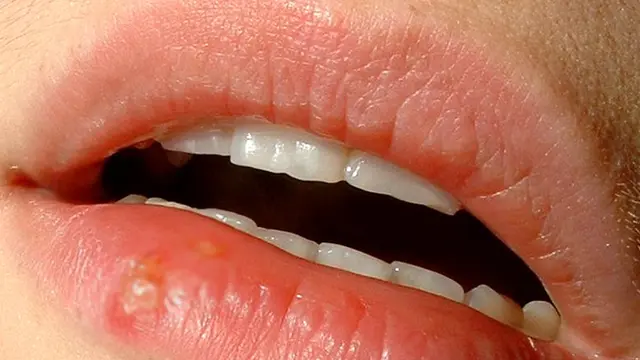 multi-sariawan-4-herpes-1130912b.jpg