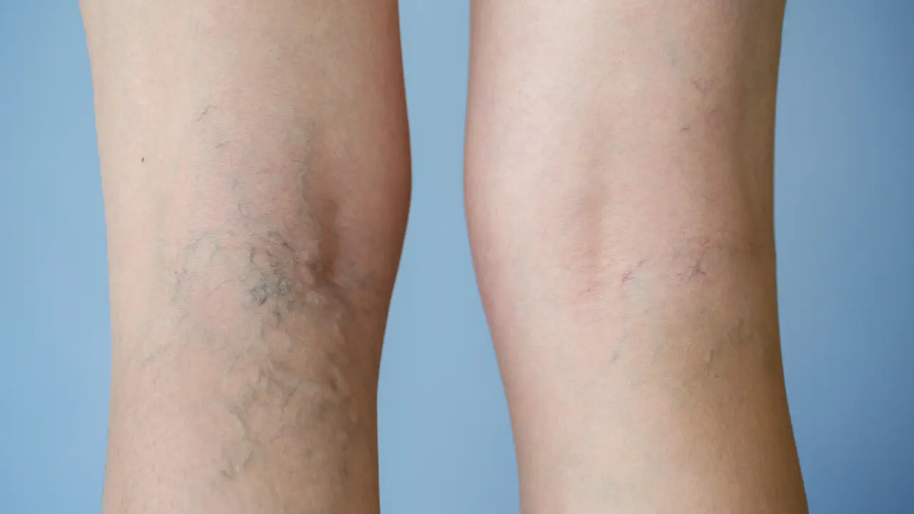 Varises (iStockphoto)
