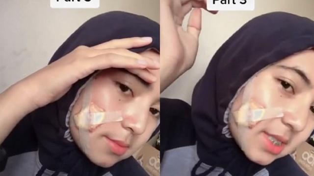 Viral Curhatan Wanita Berjerawat Hingga Harus Dioperasi Karena Pakai Masker Kain Citizen6 Liputan6 Com