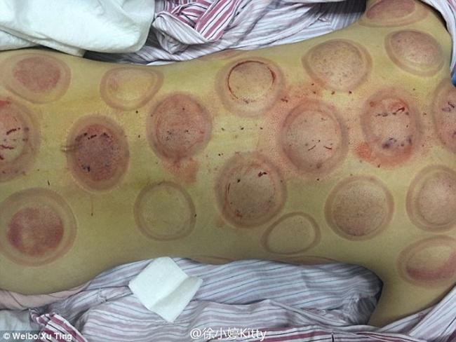Bekas bekam pada tubuh Xu Ting setelah melakukan pengobatan tradisional | Photo: Copyright dailymail.co.uk