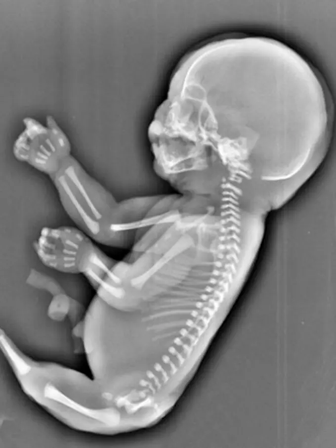 Sang Janin Idap Sindrom Mermaid, Ibu Muda Ini Pilih Aborsi