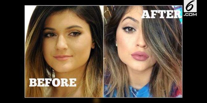 VIDEO: Kylie Jenner Lakukan 6 Operasi Plastik Ini