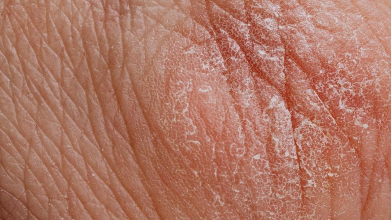 Dermatitis seboroik terkadang bisa hilang dengan sendirinya. Namun, gangguan ini bisa menjadi masalah seumur hidup. Cara mengontrolnya adalah dengan melakukan perawatan kulit.