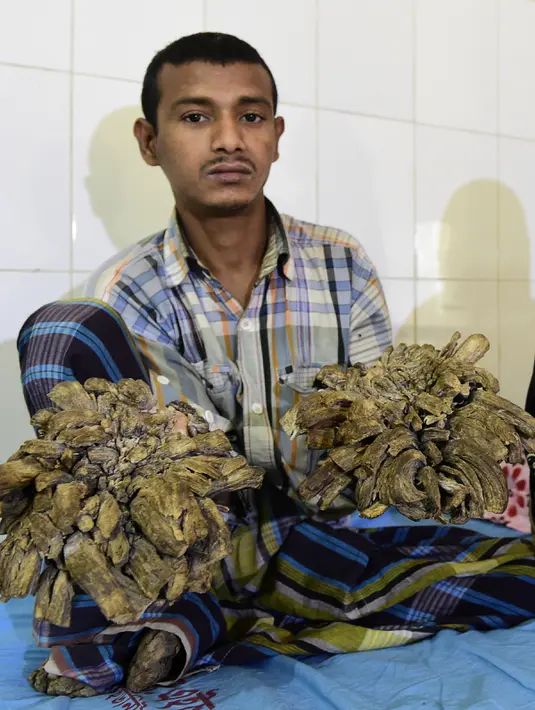 Abul Bajandar (26) menunjukkan tangannya yang ditumbuhi kutil berlebih saat dirawat di Dhaka Medical College dan Rumah Sakit, Bangladesh, Minggu (31/1). Kini kedua tangannya sudah tak bisa berfungsi sebagaimana biasanya. (AFP Photo/Munir uz ZAMAN)