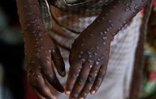 Menkes Temukan 88 Kasus Mpox di Indonesia, Semua Pasien Sudah Sembuh
