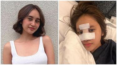 12 Foto Kronologi Dhyaz Anak Farida Nurhan Alami Infeksi Hidung hingga Angkat Implan