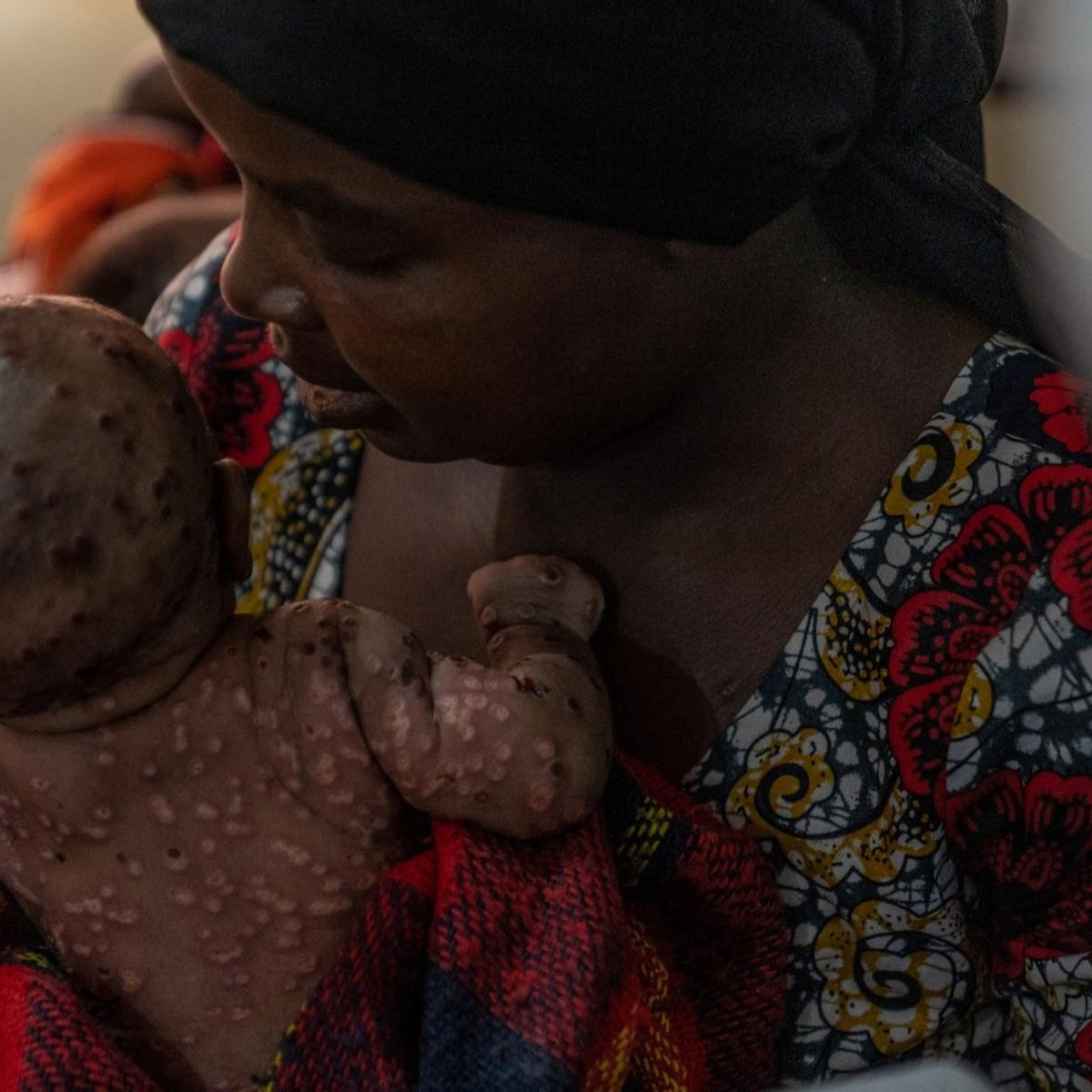 Wabah Mpox atau Cacar Monyet di Burundi