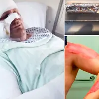 Ketika sedang mengisi ulang baterai rokok elektriknya semalaman, rokok elektrik itu meledak dan hampir menghilangkan nyawanya. 