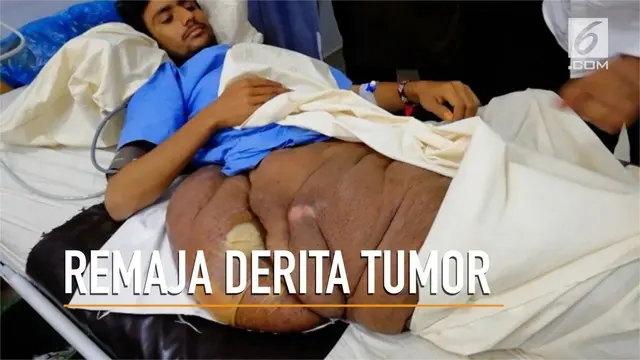 Seorang remaja di Pakistan terbaring di tempat tidur karena tumor seberat 20 kilogram di kakinya. 