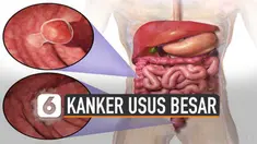 Kanker usus besar jadi salah satu penyakit kronis mematikan. Beberapa gejala kerap hadir tanpa disadari.
