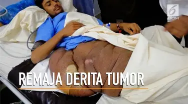 Seorang remaja di Pakistan terbaring di tempat tidur karena tumor seberat 20 kilogram di kakinya. 