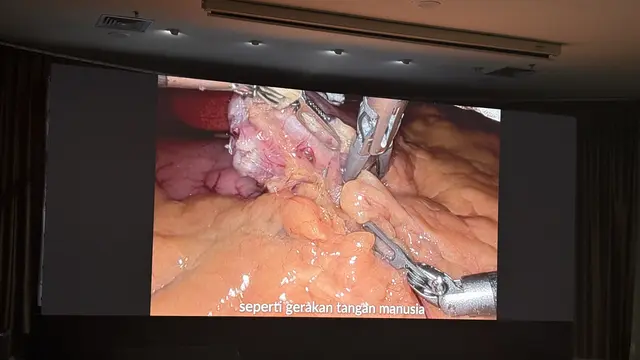 Pertama di Indonesia, RS EMC Alam Sutera Lakukan Operasi Bariatik yang Lebih Presisi dengan Robotic Surgery