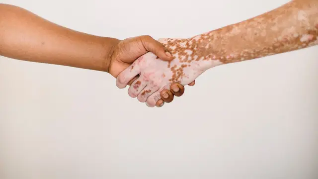 Ilustrasi Vitiligo
