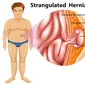 Ilustrasi penyakit hernia. (Photo created by brgfx on www.freepik.com)