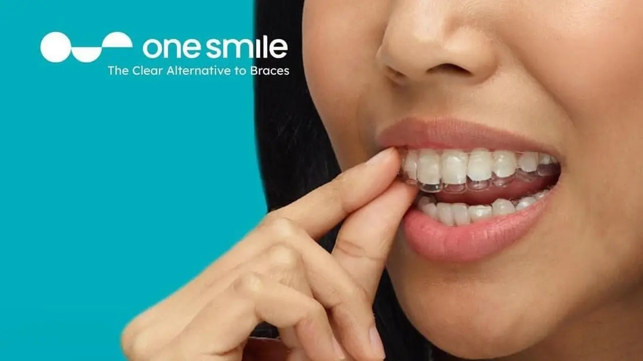 clear aligners