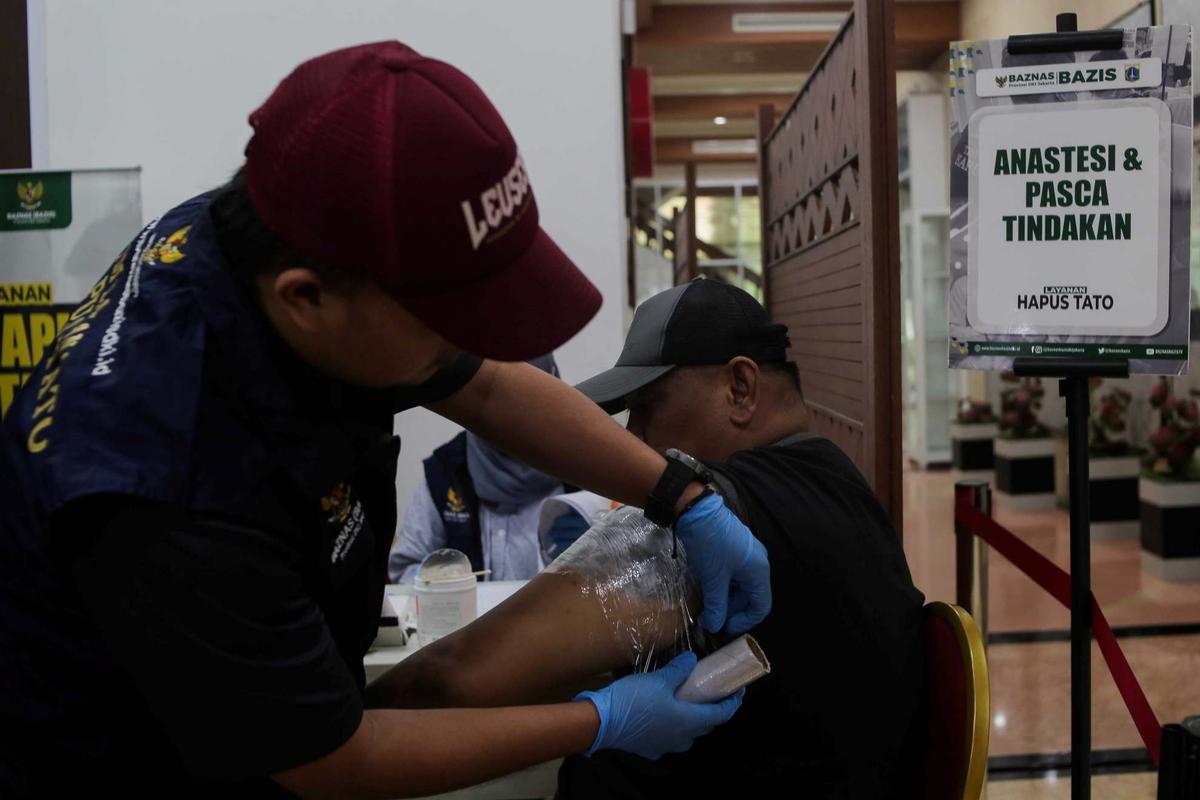 Layanan Hapus Tato Gratis di Jakarta