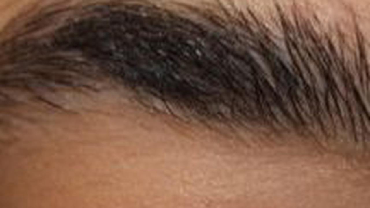 Penyebab Rambut Alis Rontok