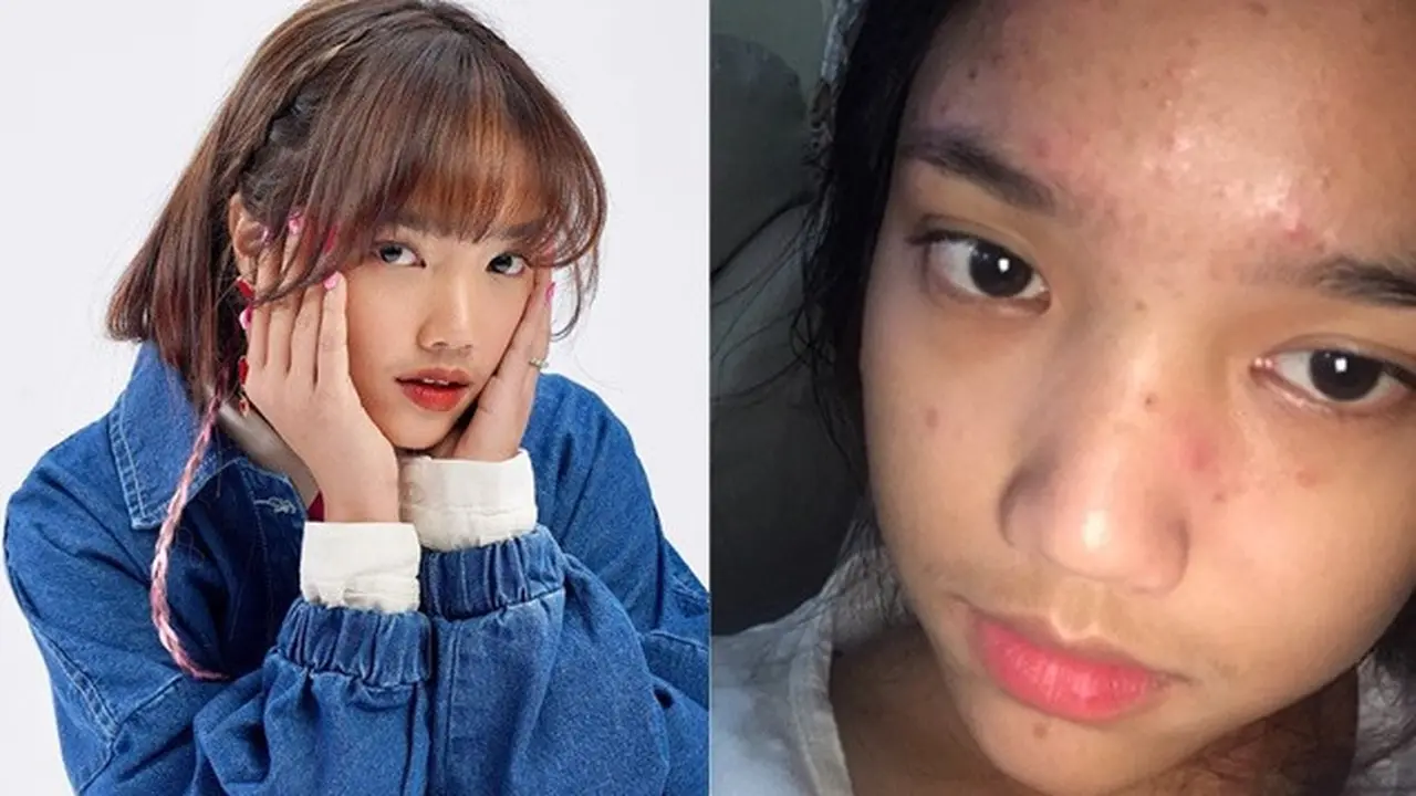 6 Potret Fuji Tanpa Makeup, Sempat Jadi Pejuang Jerawat
