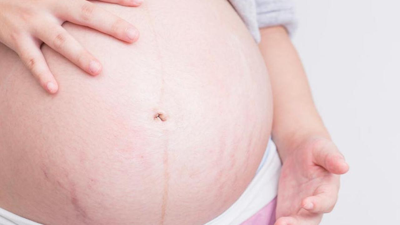 Cara Mudah Cegah Stretch Mark Saat Hamil