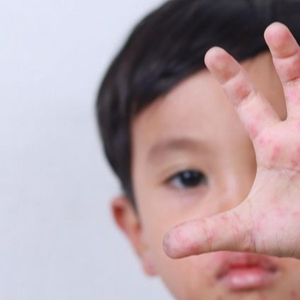 Waspada Penularan Flu Singapura Pada Anak Cenderung Meluas Saat Mudik