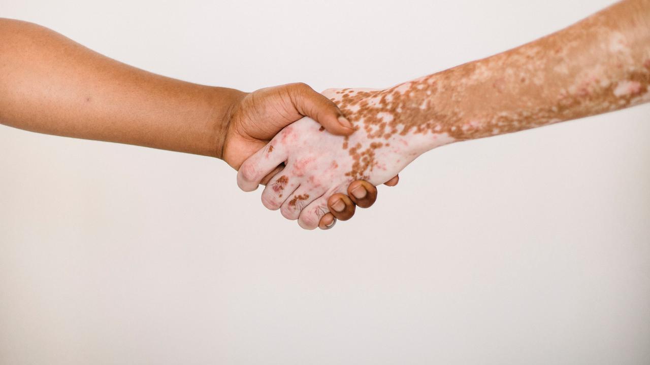 Waspadai, Penyakit Kulit Psoriasis Vulgaris Akibat Masalah Sistem Kekebalan Tubuh (pexels/armin rimoldi).