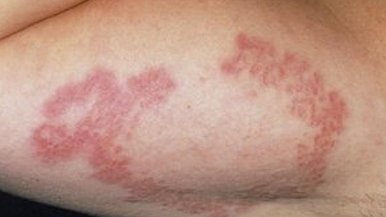 Cara Penularan Herpes Zozter