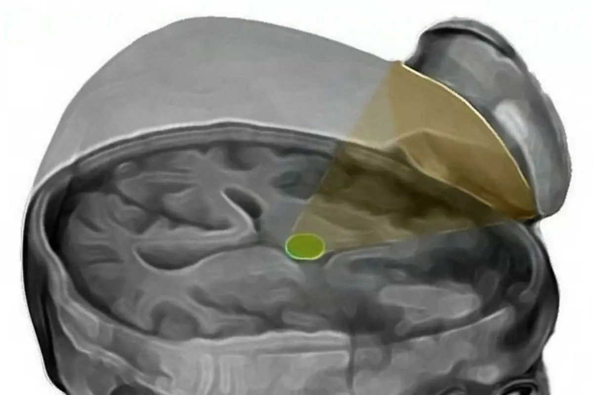 pioneering ultrasound. Foto: Mirror