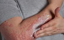 Steven Johnson Syndrome: Panduan untuk Pasien dan Keluarga dalam Proses Diagnosa