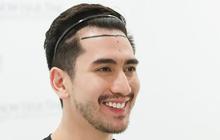 Verrell Bramasta Ungkap Pengalaman Transplantasi Rambut, Tampil Botak!