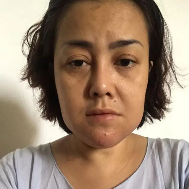 5 Potret Rency Milano Diduga Jadi Korban Malpraktik, Dagu Bengkak dan Bernanah