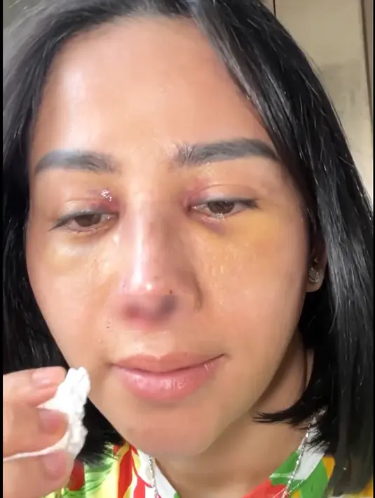 "Yay Hidungnya Omay sudah mancung, lurus, lubang hidungnya sama lagi, senangnya itu nggak bisa Omay jabarkan dengan Kalimat apapun. Tidak sakit sama sekali, mungkin karena Omay diberikan/mengkonsumsi Obat anti nyeri sampai dengan hari ini." Tulis dalam unggahan 7 November. [Instagram/farida.nurhan]