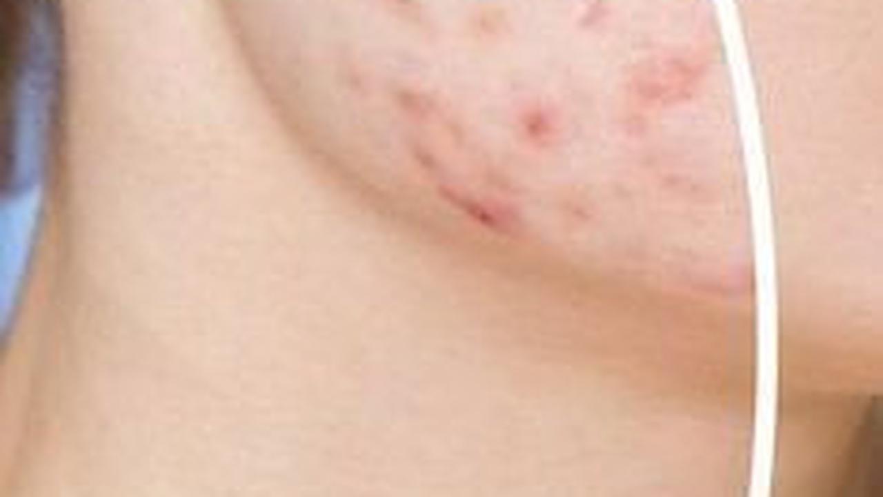 Bolehkah Wajah Berjerawat Menggunakan Serum?
