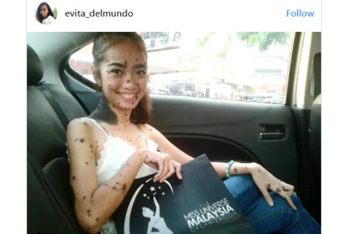tahi lalat miss universe