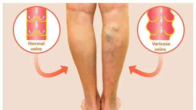 Pengertian Vena dan Varises Vena