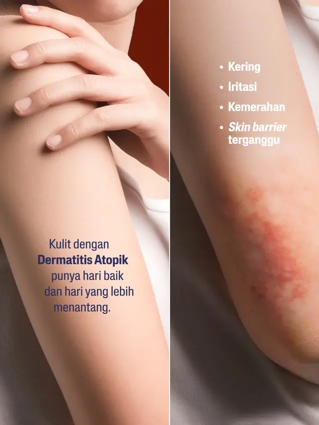 Kulit eksim