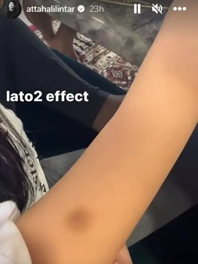 Tangan Arsy Hermansyah Lebam setelah  Bermain Lato-Lato