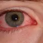 Mata yang berwarna merah muda, gatal, dan berair ini memang sangat menular apabila disebabkan bakteri dan virus.