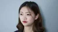 Stress Breakout Bikin Jerawat Bermunculan, Ini Cara Mengatasinya
