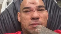 Petarung MMA, Evangelista "Cyborg" Santos, mengalami retak tulang tengkorak setelah terkena terjangan lutut Michael "Venom" Page pada ajang Bellator 158, Sabtu (16/7/2016). (MMA Fighting)