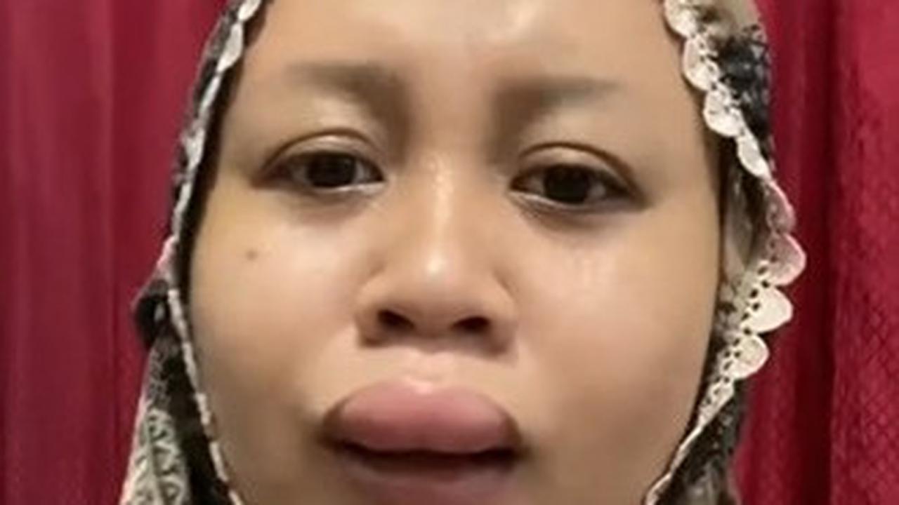 Nasib Apes Jelang Pernikahan, Bibir Wanita Ini Tiba-tiba Jeding