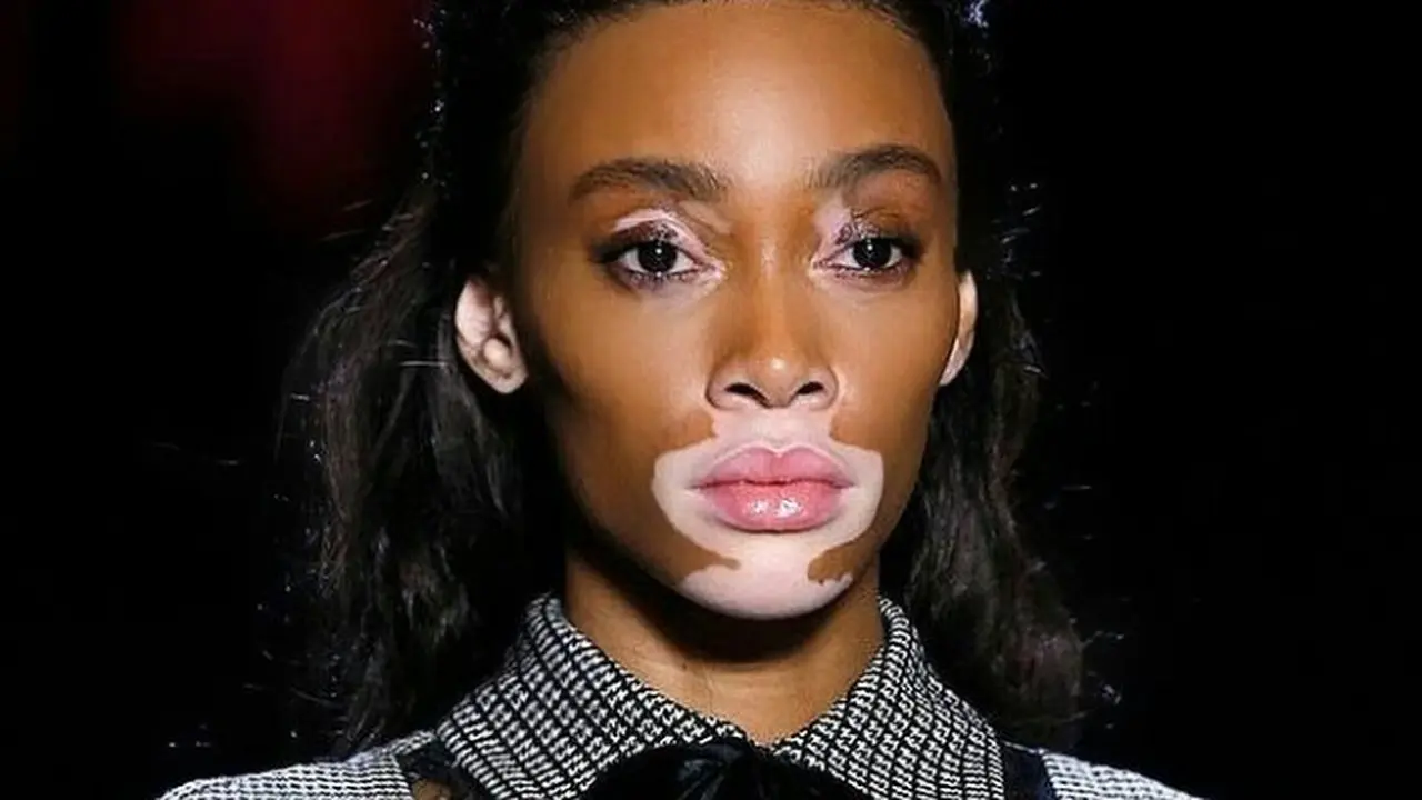Vitiligo Bisa Sebabkan Depresi, Dukungan Positif Mempercepat Penyembuhan