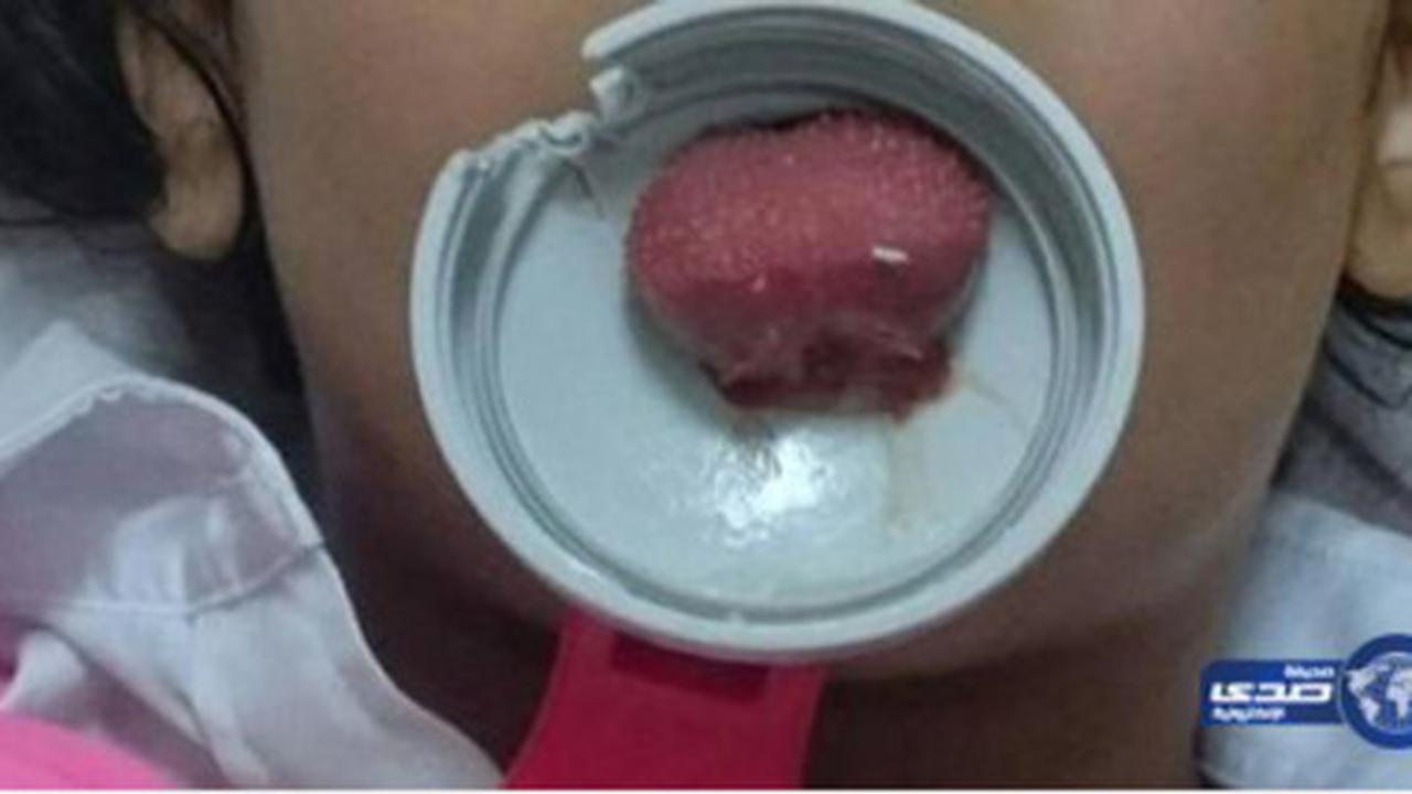 Miris! Lidah anak Saudi nyangkut di tutup botol