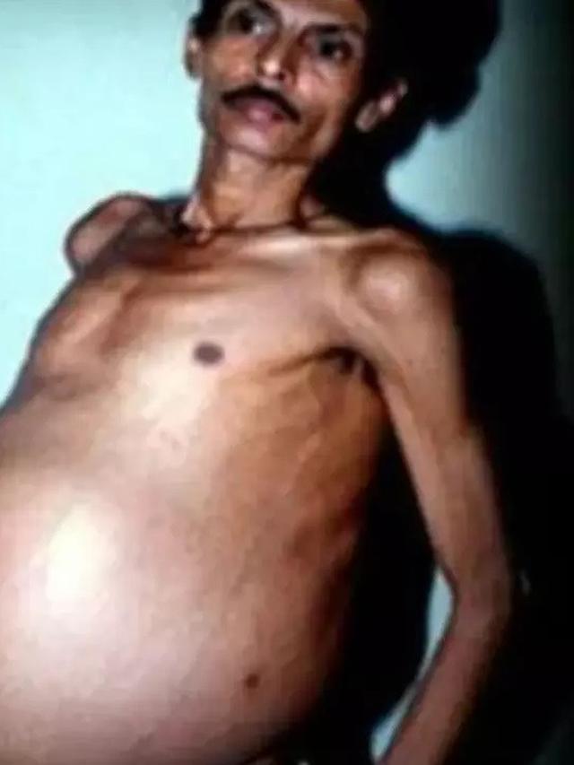 Pria Punya Kembaran di Dalam Perut