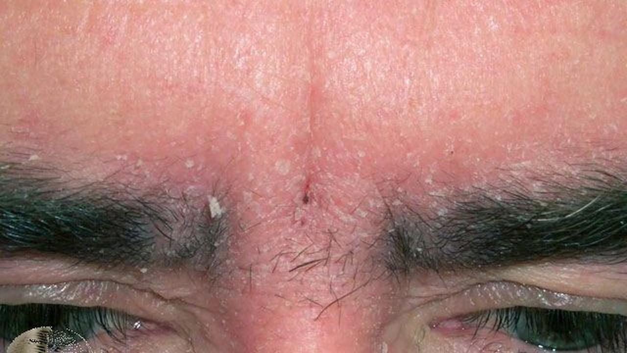 Faktor Risiko Orang Terkena Dermatitis Seboroik