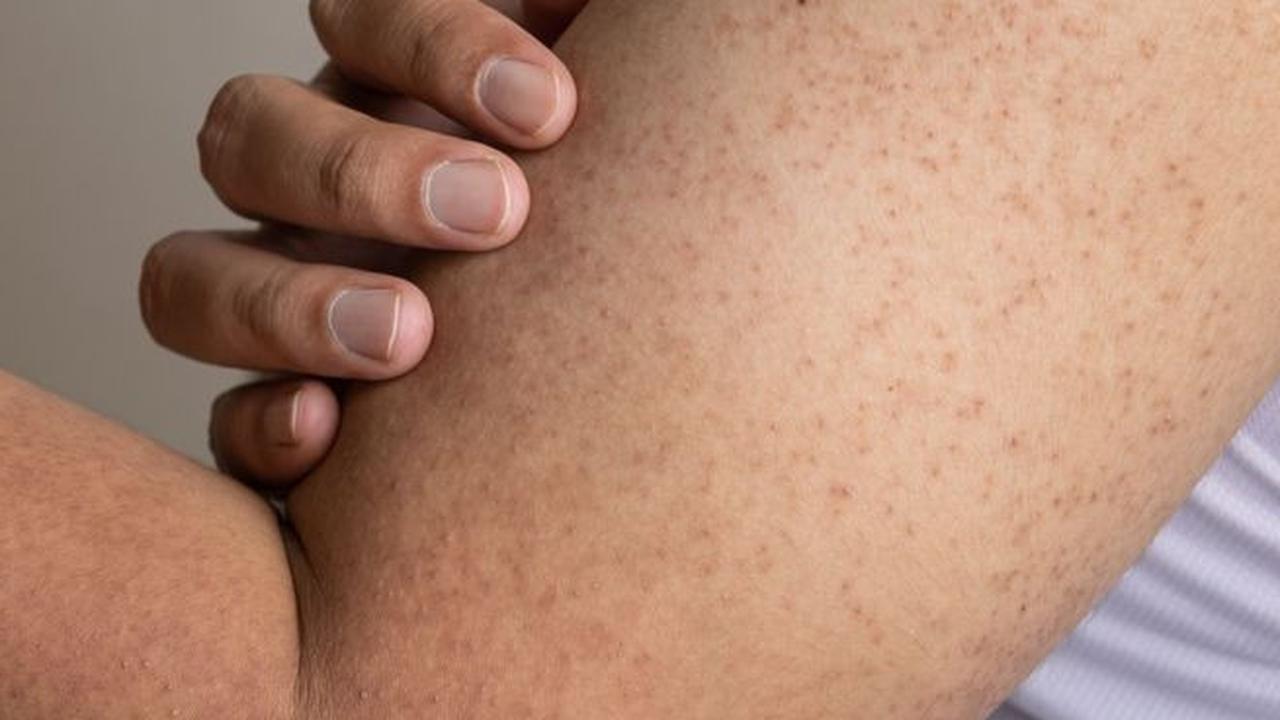 Keratosis Pilaris atau ‘Kulit Ayam’ Tak Lagi Menyebalkan, Panduan Lengkap Perawatan Kulit yang Tepat