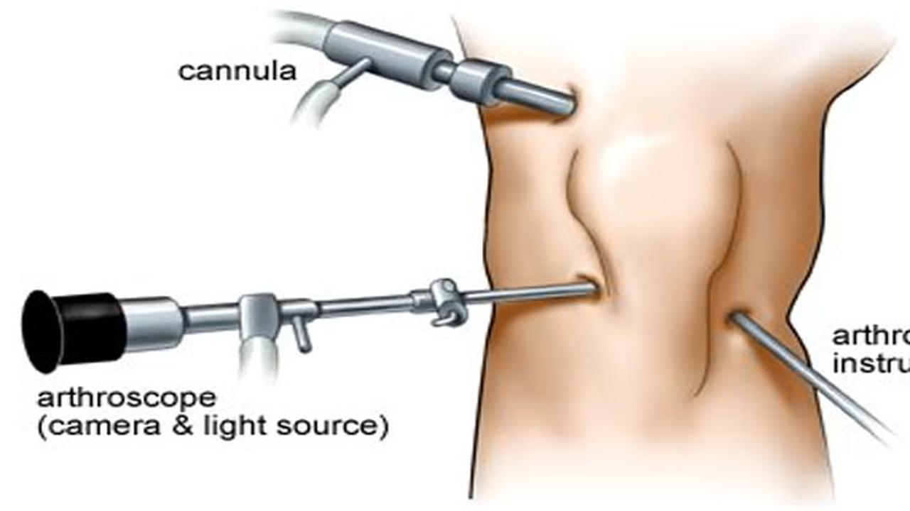 Artroskopi, Operasi Canggih Penyelamat Sendi