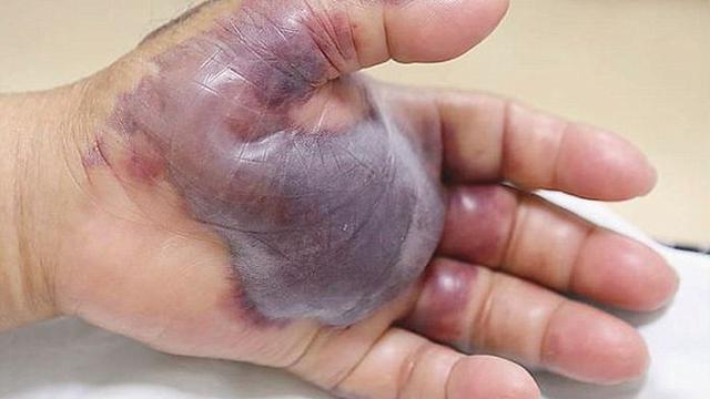 Lengan Pria Ini Diamputasi Usai Makan Sushi