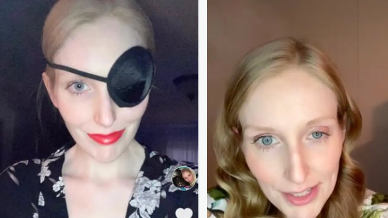 Akibat Suntik Botox Gagal, Mata Kanan Wanita Ini Tak Bisa Dibuka Selama Sebulan